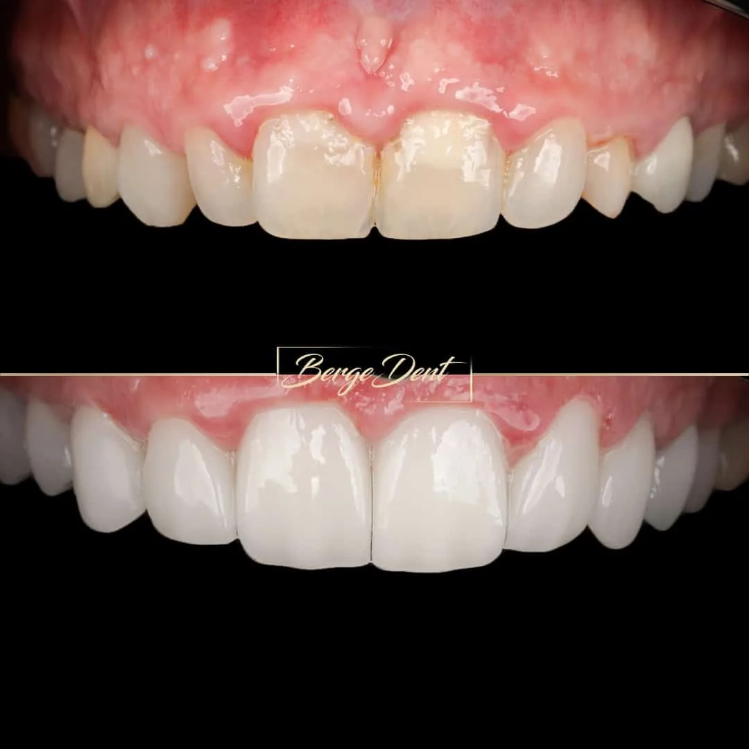 full mouth reconstruction bergedent istanbul