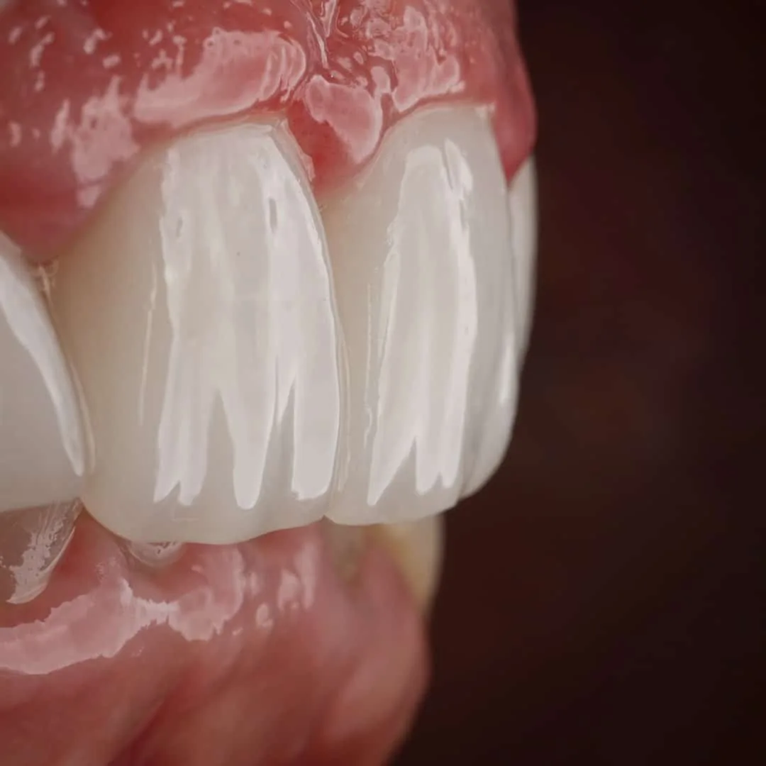 smile design before after bergedent