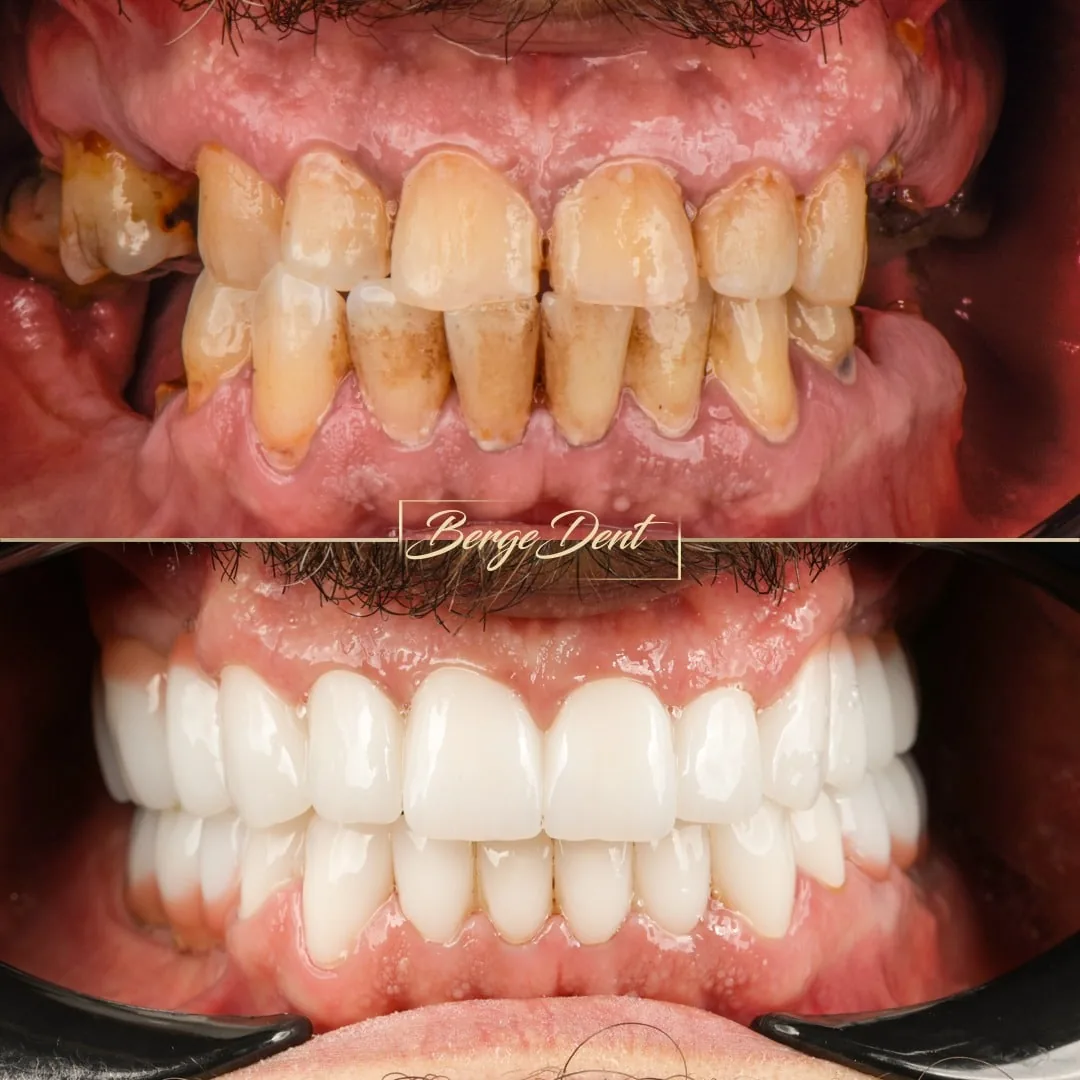 zirconia crowns before after turkey