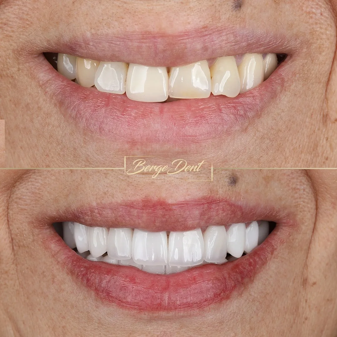 dental crowns before after istanbul turkey