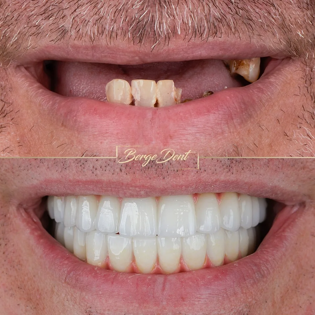 Dental Work in Turkey