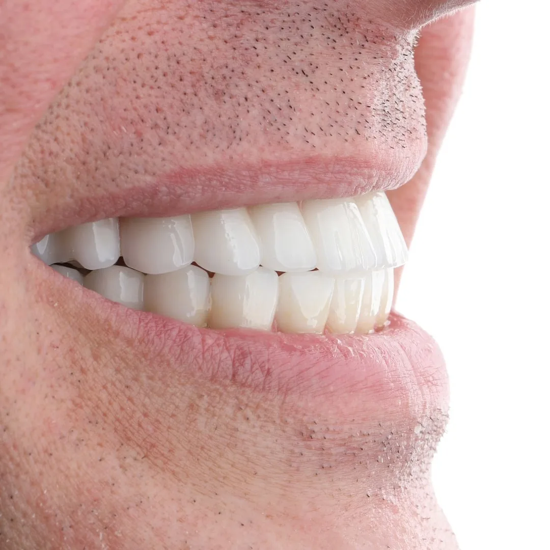full smile transformation bergedent istanbul