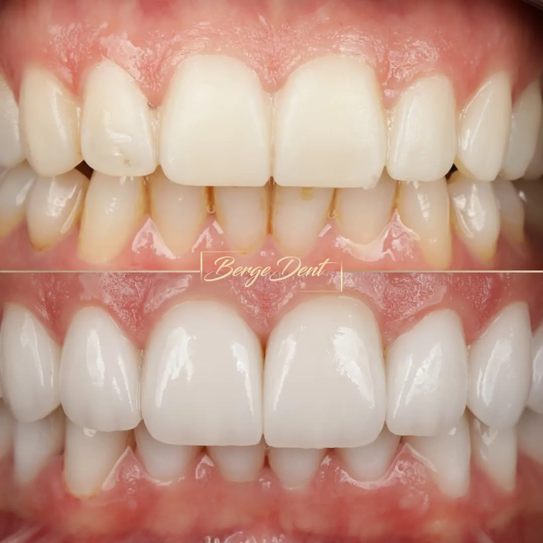 veneer before after istanbul