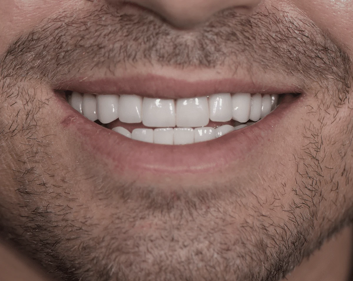 implants before after bergedent istanbul
