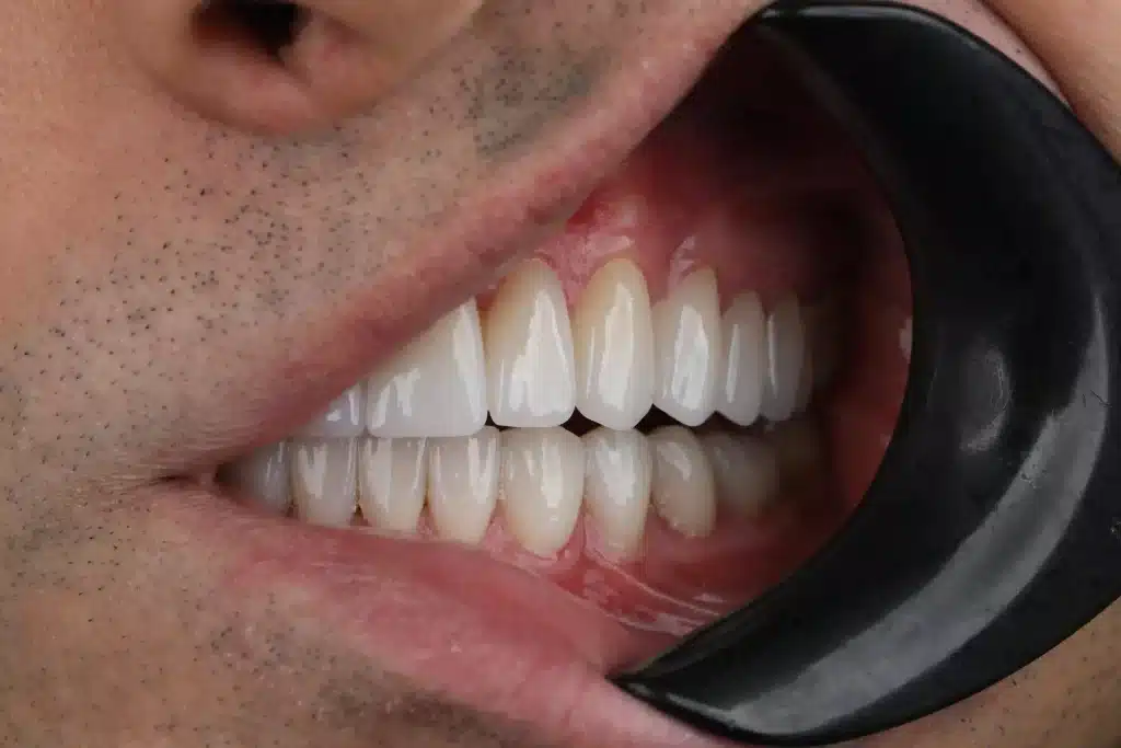 Turkey Teeth smile makeover Istanbul